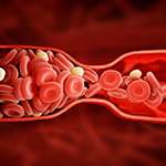 Groundbreaking Blood Clot Prevention Trial Receives Prestigious Clinical Research Award